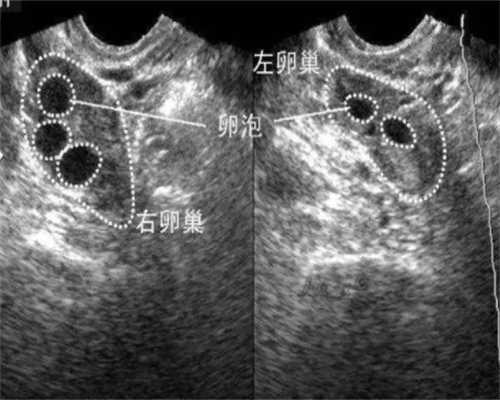 代生儿子中介胎停化验胚胎有必要吗